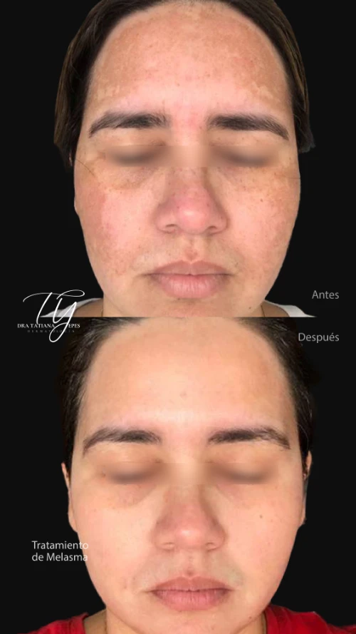 Melasma-02.webp