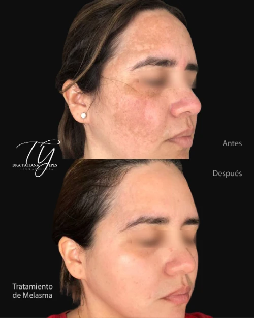 Melasma-03.webp
